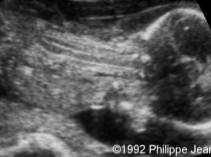 <ol><li><p>What is abnormal about this image?</p></li><li><p>This finding can be associated with what pathologies?</p></li></ol><p></p>