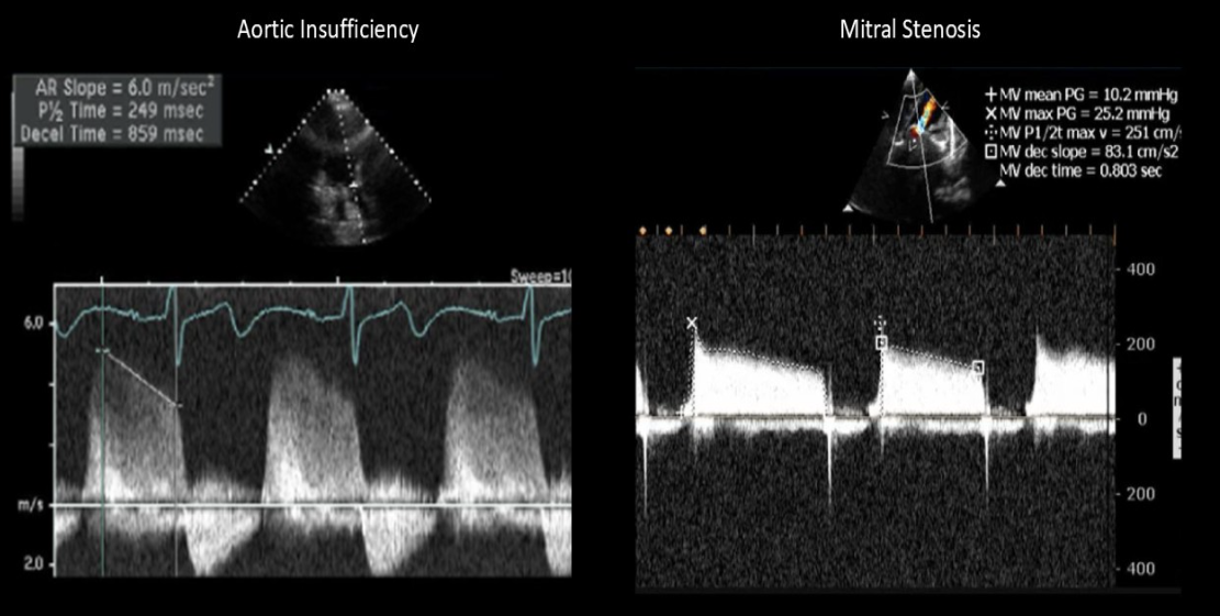 <p>How do you differentiate severe MS from AI on Doppler evaluation?</p>