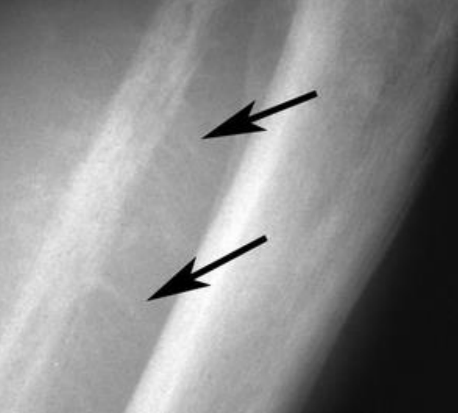 <p>Which periosteal reaction is this?</p>
