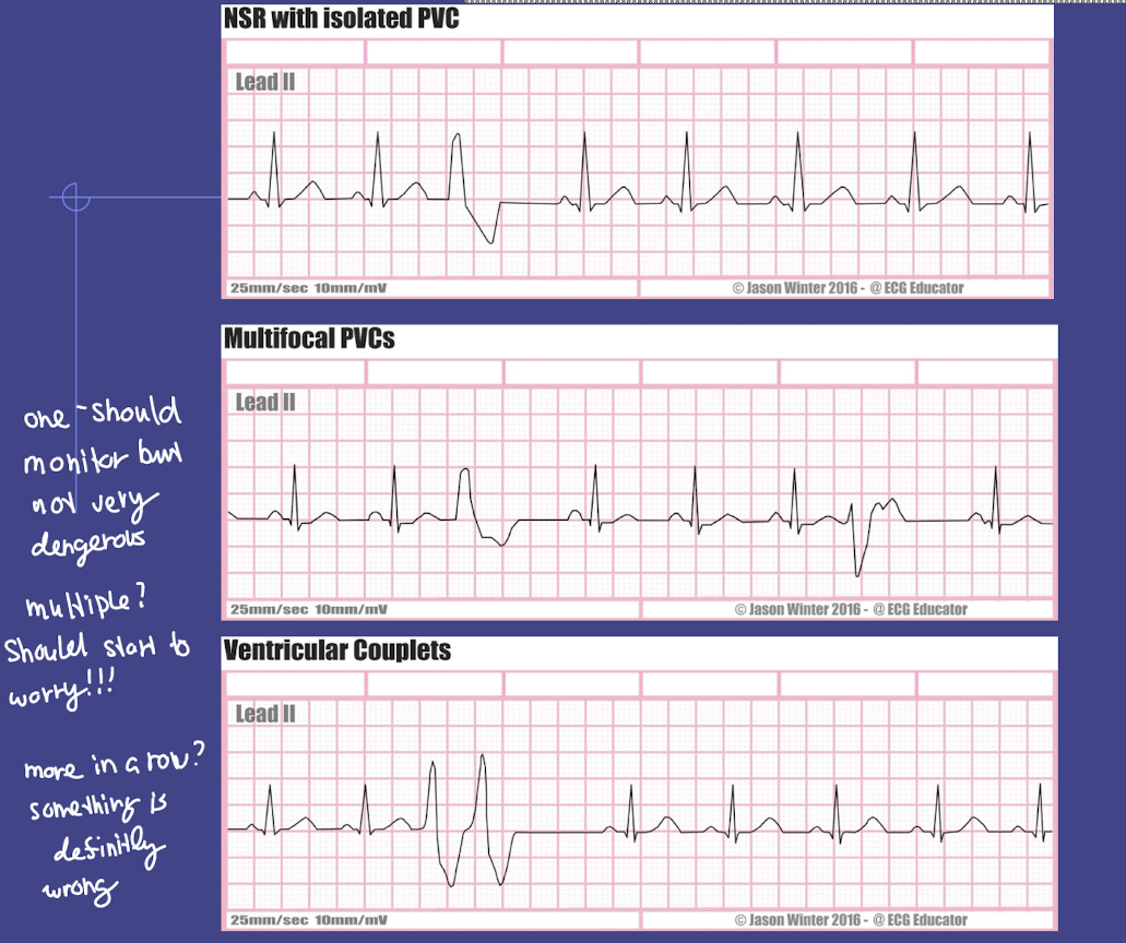 <ul><li><p>Two consecutive PVCs → indicates <strong>higher risk of ventricular tachycardia</strong></p></li><li><p>Nursing action: Continuous ECG monitoring; notify provider if sustained</p></li></ul><p></p>