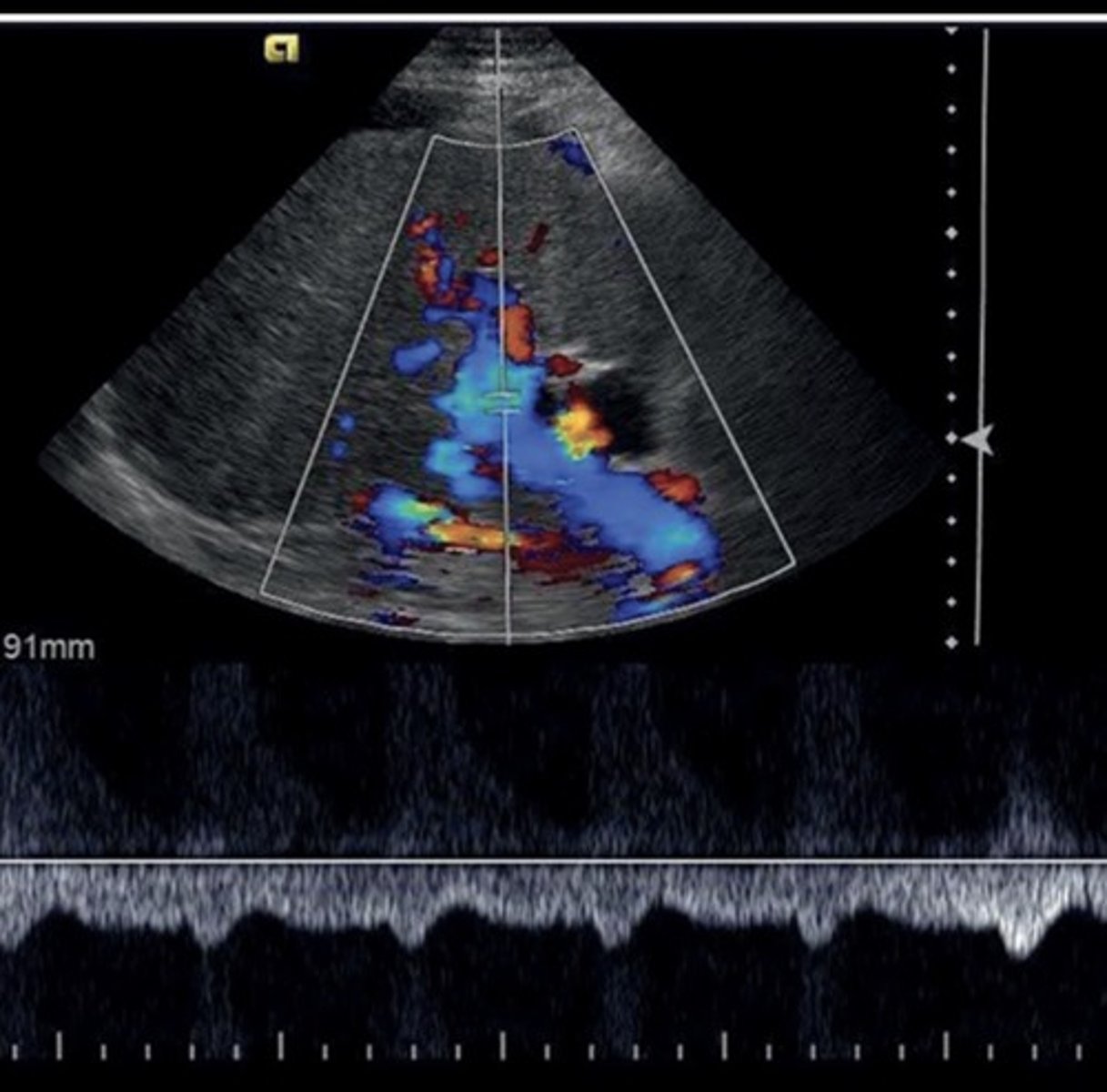 <p>Slow, hepatofugal flow in portal vein</p>