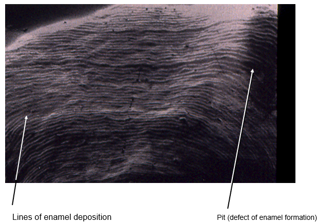 <p>What is the cause of a defect in enamel formation?</p>