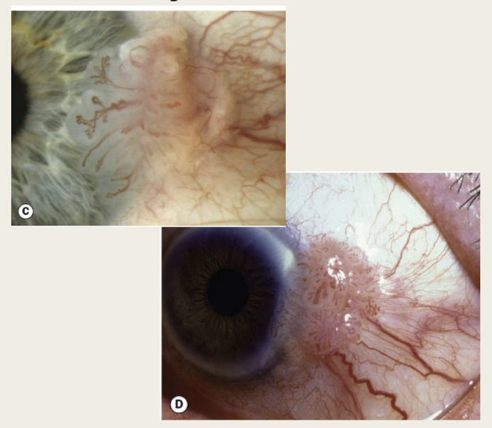 <p>slowly progressive lesion that can be benign, premalignant, or malignant</p>