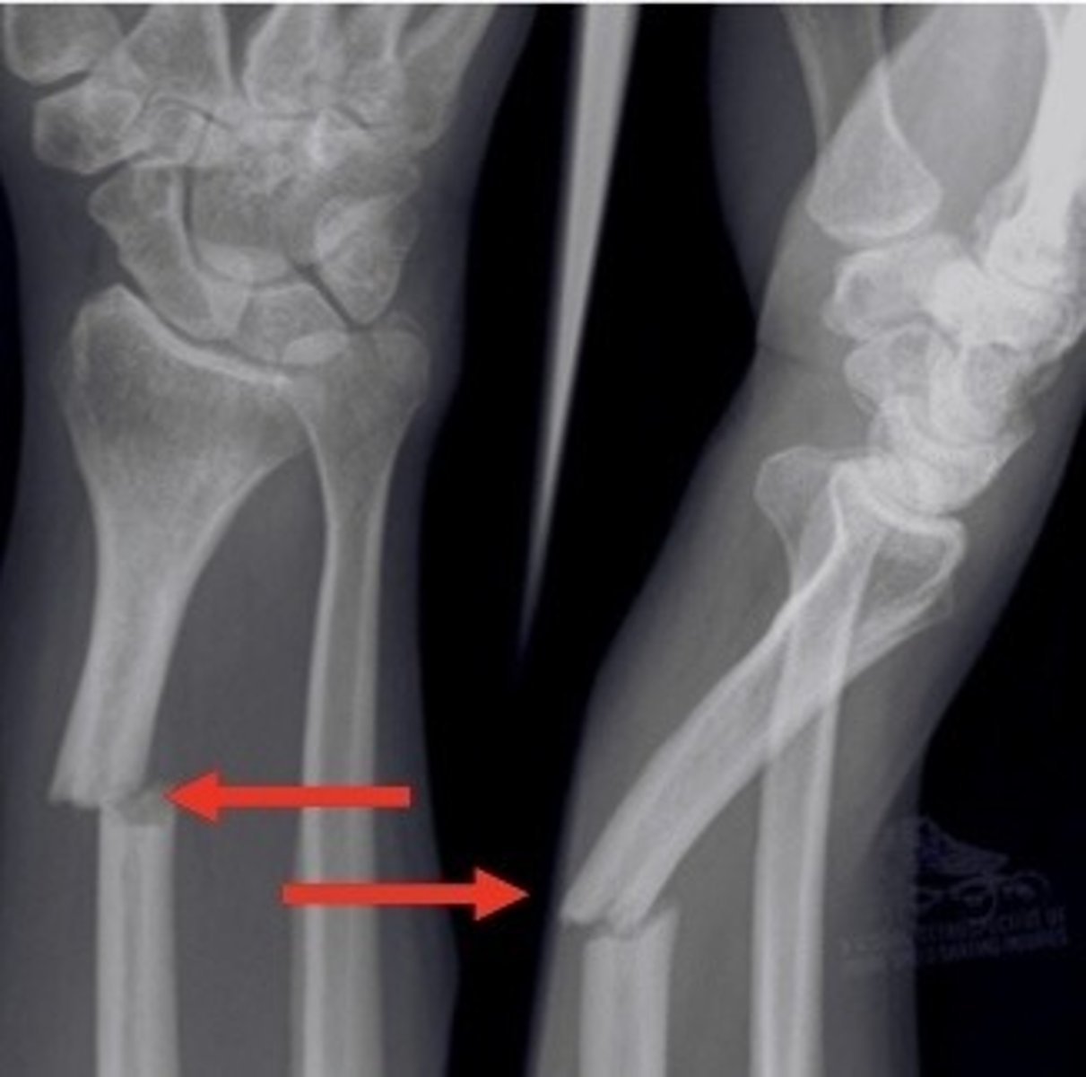 <p>What type of fracture is shown?</p>