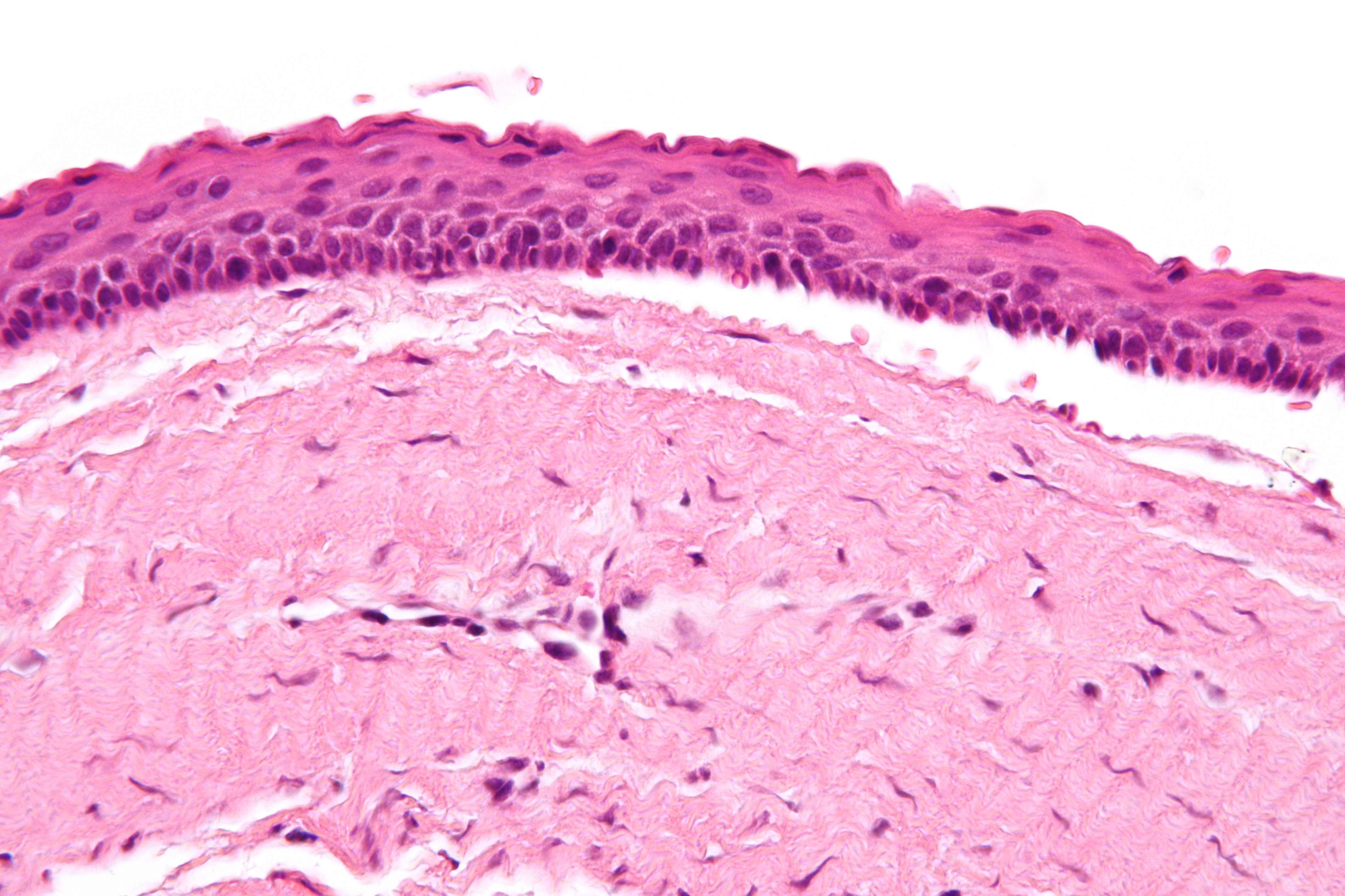 <p>1) kératokyste odontogénique </p><p>2) clarté locale, associé au syndrome de Gorlin, localement agressif </p><p>3)</p><ul><li><p>Kyste uniloculaire</p></li><li><p>Epithélium stratifié fin</p></li><li><p>Parakératose avec corrugation </p></li></ul><p></p>