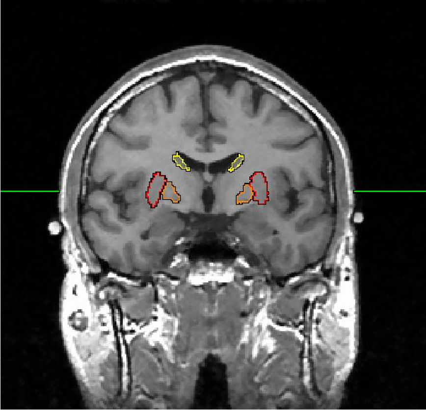 <p>includes cortex, basal ganglia (putamen, caudate nucleus, globus pallidus) &amp; limbic system (hippocampus/ amygdala) </p>