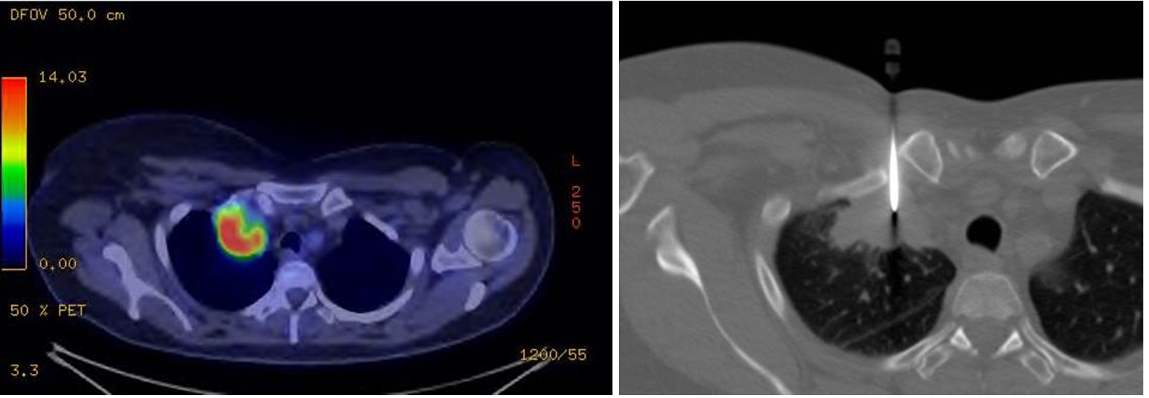 <p>Patient history: heavy smoker for three decades, right shoulder pain at present in a middle-aged patient</p><p>Modality: PET-CT; 18-fluorodeoxyglucose (18F-FDG) radiotracer fused image (left); non-enhanced chest CT with bone window, core biopsy (right)</p><p>Region: chest, lung </p><p>Radiologic sign:Increased 18F-FDG uptake in the right apical mass;</p><p>Diagnosis: CT-guided core biopsy from the right apical mass. Pancoast-tumor, lung core biopsy</p>