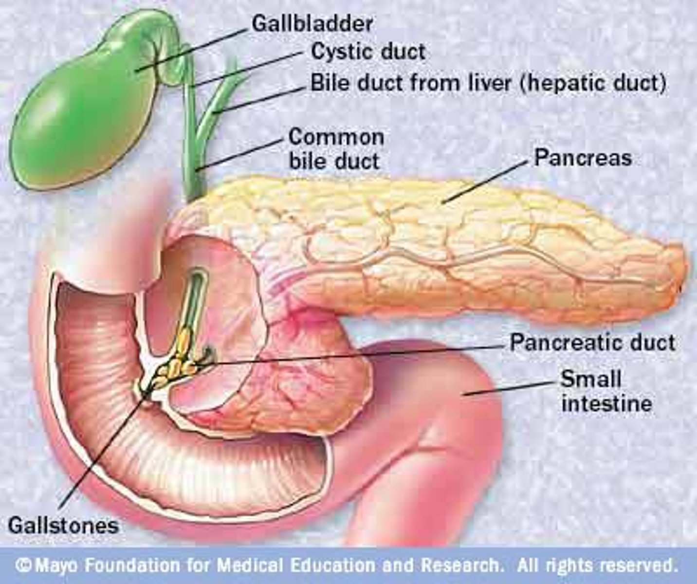 <p>inflammation of the pancreas</p>