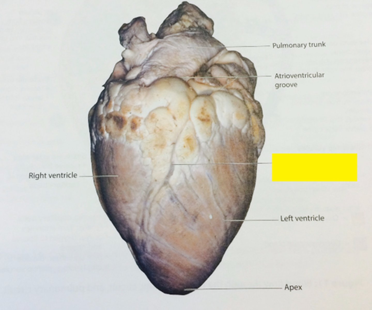 <p>Slanted depression between the two ventricles. Coronary vessels can usually be seen in this depression.</p>