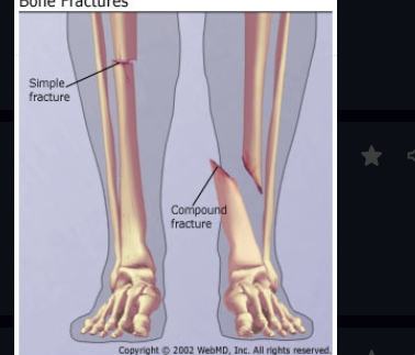 Compound fracture
