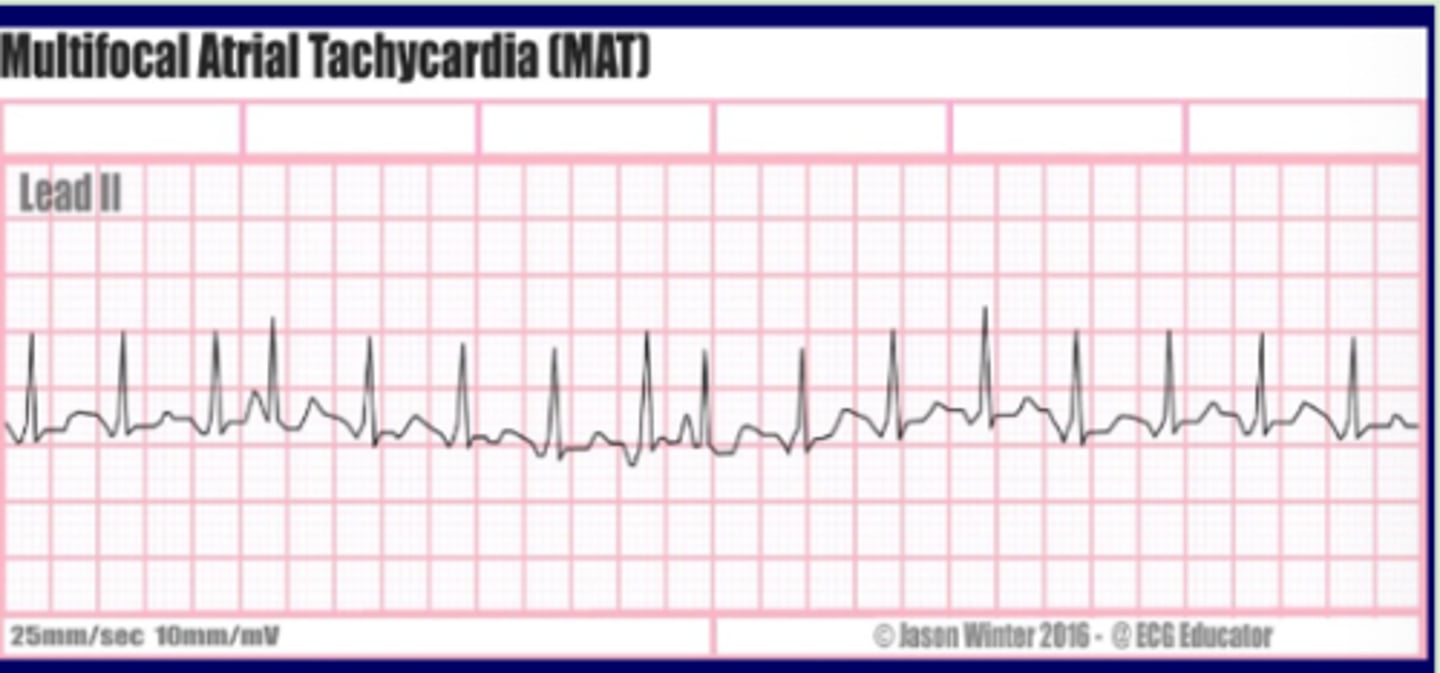 <p>Originate: multiple rapidly firing atrial impulses</p><p>QRS complex: narrow</p><p>P wave: different</p><p>Heart rate: &gt;100 bpm</p><p>R-R intervals: irregularly irregular</p>