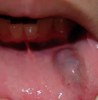 <p>What is a mucocele?</p>