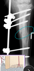 <p><span style="background-color: transparent;"><strong>Indirect (Secondary) Bone Healing</strong></span></p>