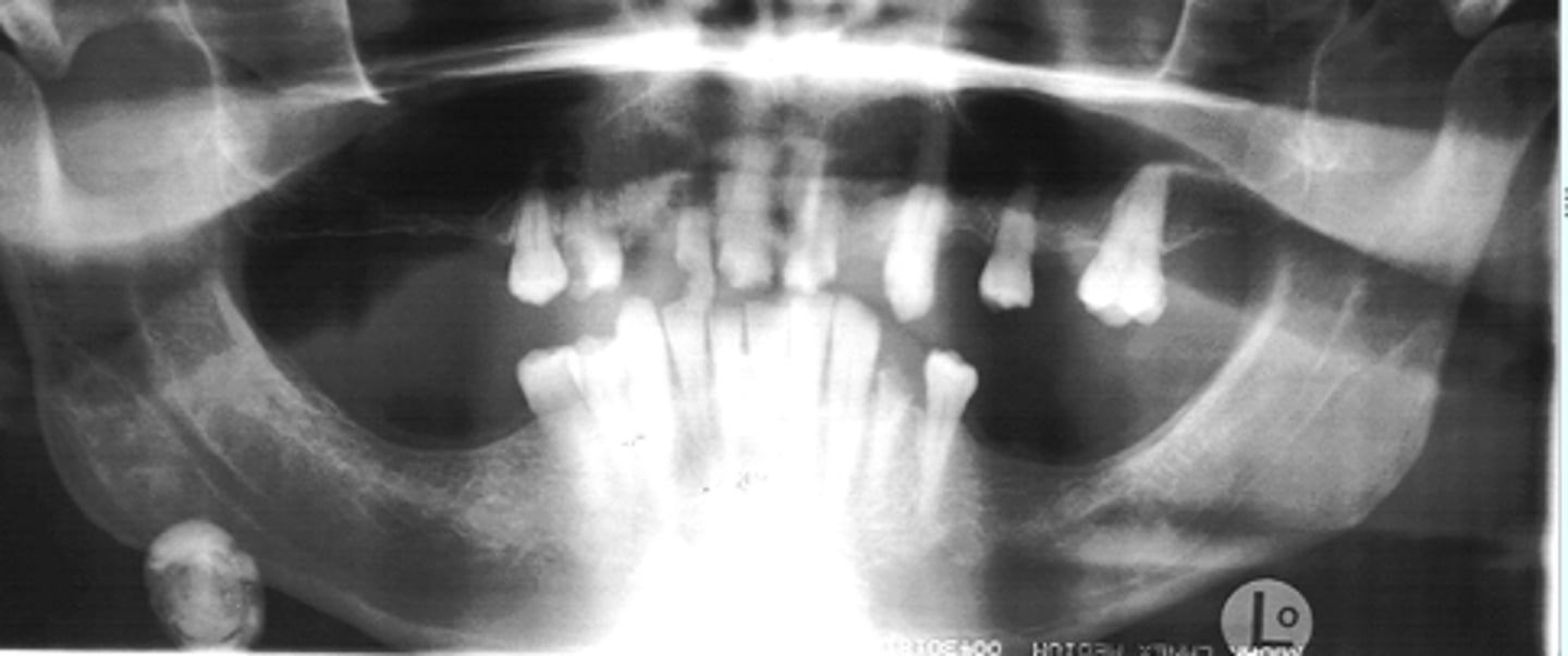 <p>ID the calcified abnormality:</p>