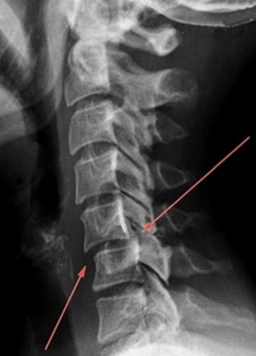 <p>What type of dislocation is shown?</p>