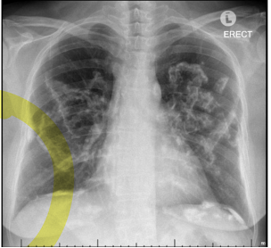 <p><span>a.</span><span style="font-family: &quot;Times New Roman&quot;; line-height: normal; font-size: 7pt;">&nbsp;&nbsp;&nbsp;&nbsp;&nbsp;&nbsp;&nbsp; </span><span>Of work in old buildings or ships (like up <em>high</em> in an old building) 10+ YEARS</span></p><p class="MsoListParagraphCxSpMiddle"><span>b.</span><span style="font-family: &quot;Times New Roman&quot;; line-height: normal; font-size: 7pt;">&nbsp;&nbsp;&nbsp;&nbsp;&nbsp;&nbsp;&nbsp; </span><span>Physical exam: crackles</span></p><p class="MsoListParagraphCxSpMiddle"><span>c.</span><span style="font-family: &quot;Times New Roman&quot;; line-height: normal; font-size: 7pt;">&nbsp;&nbsp;&nbsp;&nbsp;&nbsp;&nbsp;&nbsp; </span><span>Imaging: chest X-ray showing thickened pleura, calcified plaque on diaphragms or lateral chest wall, may have holly leaf sign (looks like beef in the lung)</span></p><p class="MsoListParagraphCxSpMiddle"><span><em>d.</em></span><span style="font-family: &quot;Times New Roman&quot;; line-height: normal; font-size: 7pt;">&nbsp;&nbsp;&nbsp;&nbsp;&nbsp;&nbsp;&nbsp; </span><span><em>Located in lower lungs</em></span></p><p class="MsoListParagraphCxSpMiddle"><span>e.</span><span style="font-family: &quot;Times New Roman&quot;; line-height: normal; font-size: 7pt;">&nbsp;&nbsp;&nbsp;&nbsp;&nbsp;&nbsp;&nbsp; </span><span>Smoking plus asbestosis causes a very high risk of lung cancer then either by itself (consider mesothelioma)</span></p><p class="MsoListParagraphCxSpLast"><span>f.</span><span style="font-family: &quot;Times New Roman&quot;; line-height: normal; font-size: 7pt;">&nbsp;&nbsp;&nbsp;&nbsp;&nbsp;&nbsp;&nbsp;&nbsp;&nbsp;&nbsp; </span><span>Treatment remove exposure, oxygen</span></p>