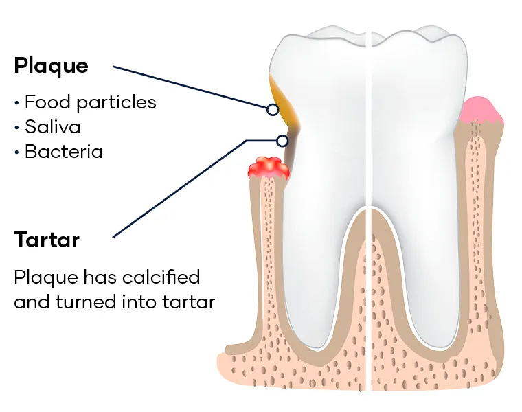 <ol><li><p>Plaque: microorganisms form in a matrix of salivary glycoproteins and extracellular polysaccharides, adhere to tooth covering</p></li><li><p>Complicated by bacteria: Actinomyces, Streptococcus, Porphyromonas gingivalis, Fusobacterium, Prevotella</p></li><li><p>Tartar: mineralised plaque &gt;2 weeks in duration</p><ol><li><p>Forms in layers, separated by organic cuticle, mineralised plaque forms from saliva and sulcular fluid</p></li></ol></li></ol><p></p>