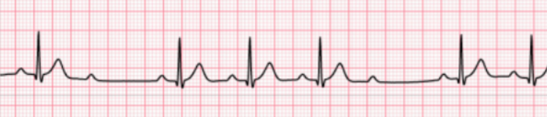 <p>Determine the A-V dysrhythmia (blocks):</p><ul><li><p><span>Prolonged-same-prolonged-same- drop of QRS (PR interval length</span></p></li><li><p><span>Rate can occur at any basic rate</span></p></li><li><p><span>Rhythm is irregular due to blocked beats</span></p></li><li><p><span>P waves are usually regular and precede each QRS</span></p></li><li><p><span>PR interval is constant before conducted beats. The PR interval preceding the pause is the same as that following the pause</span></p></li><li><p><span>QRS complex is usually wide due to associated bundle branch block</span></p></li></ul><p></p>
