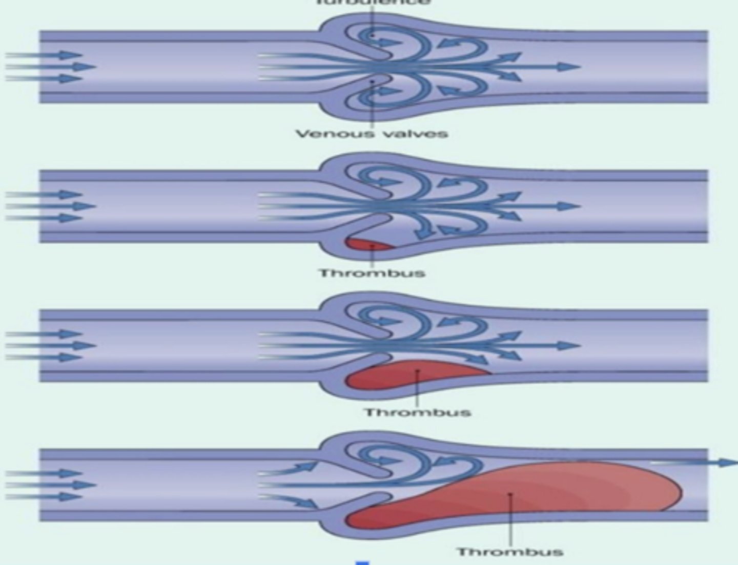 <p>- The thrombus can continue to enlarge progressively, usually in the direction of the heart.</p>