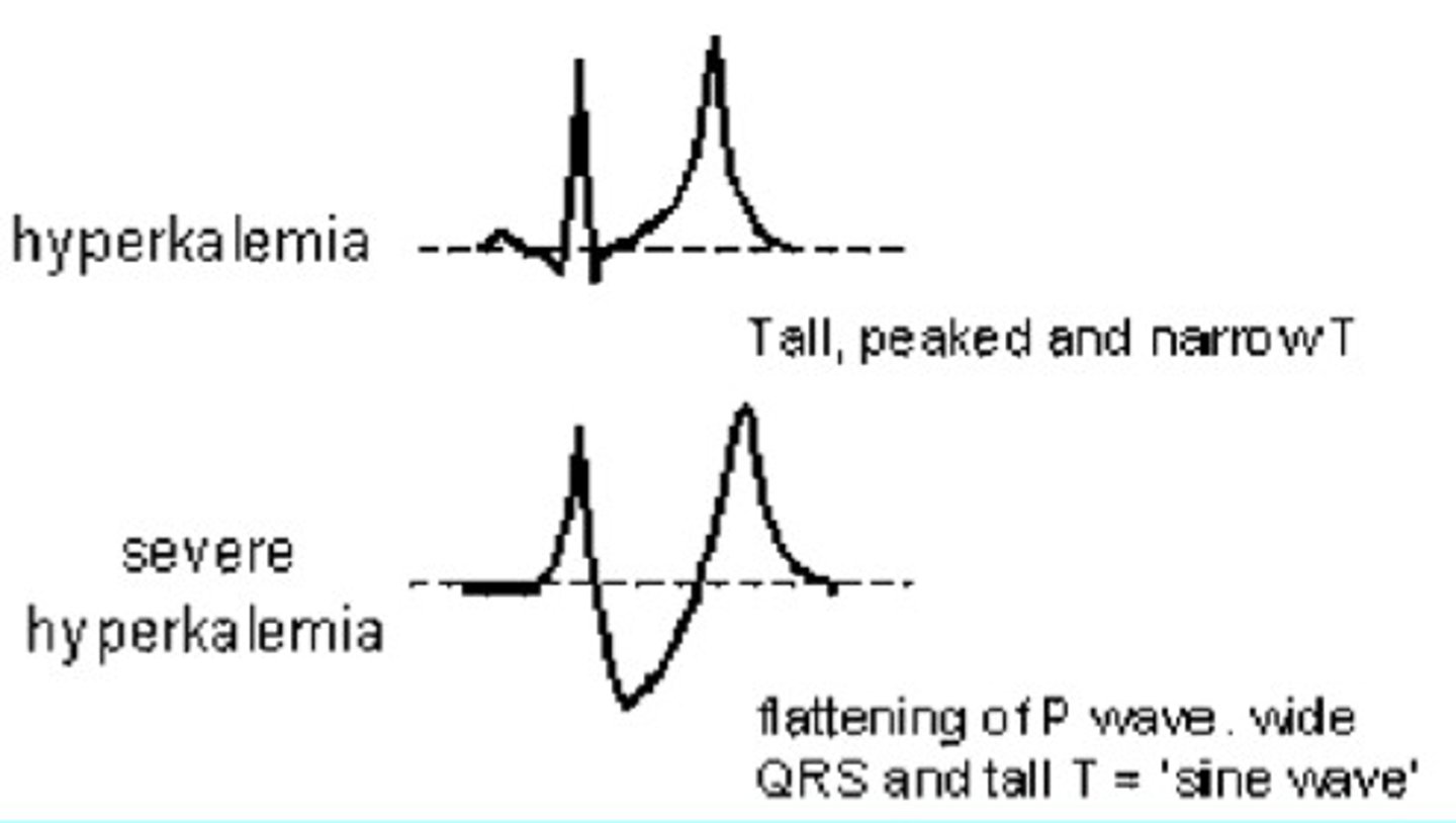 <p>tall, peaked and narrow T</p><p>severe --&gt; flattening of P wave, wide QRS, and tall T='sine wave'</p>