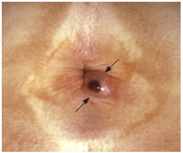 <p>57 y/o male presents to the clinic for rectal bleeding. He states that when he wipes, its bright red and he feels some “lumpy stuff” back there. On physical exam you note a erythematous, perianal nodule that is firm and tender to the touch. It’s acute thrombosed so what’s your treatment plan?</p>