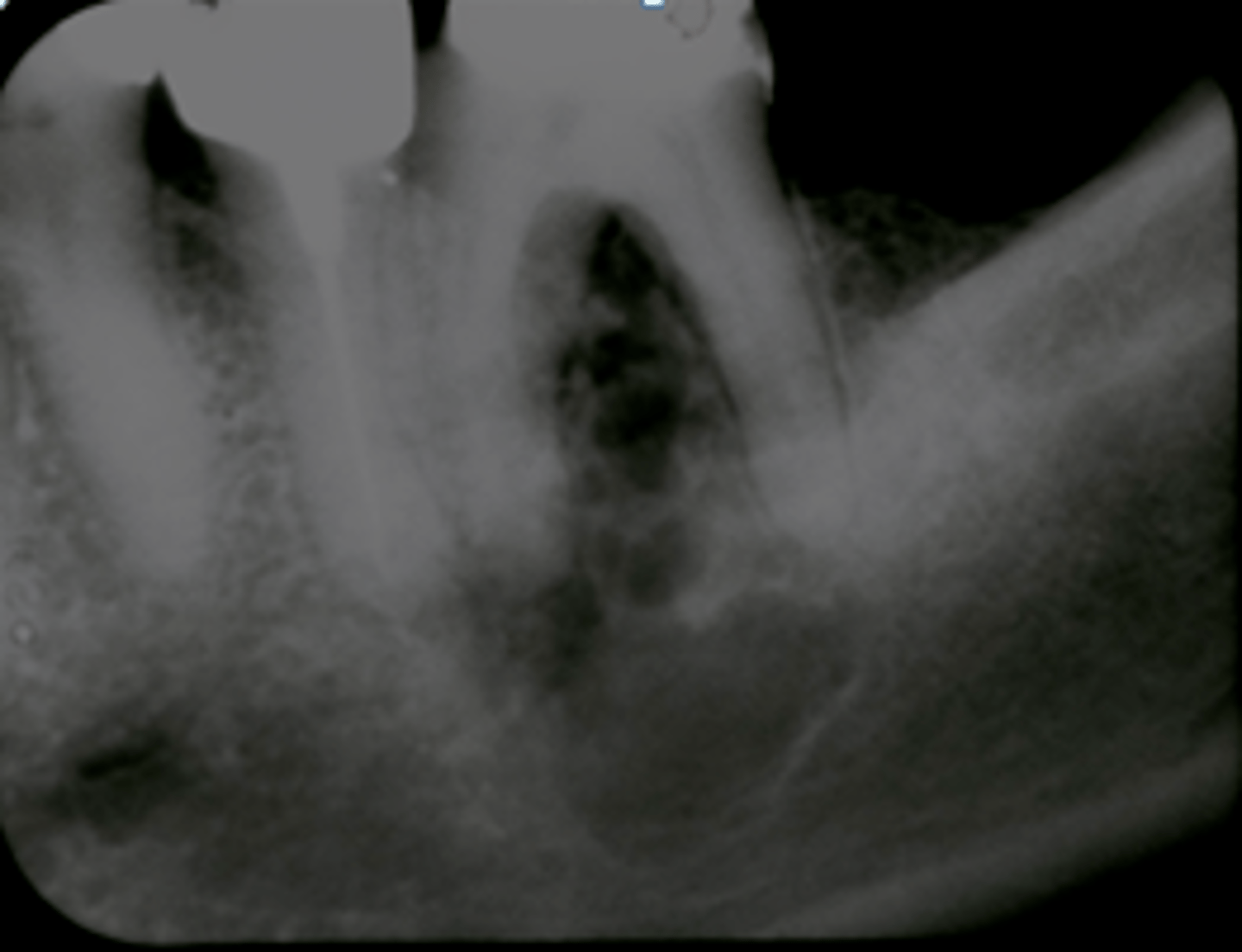 <p>patient presents with radiolucent lesion with a mix of well and ill defined margins, that has a "sun-ray" or 'honeycomb" periosteal reaction pattern that causes displacement of teeth and root resorption. What is the diagnosis?</p>
