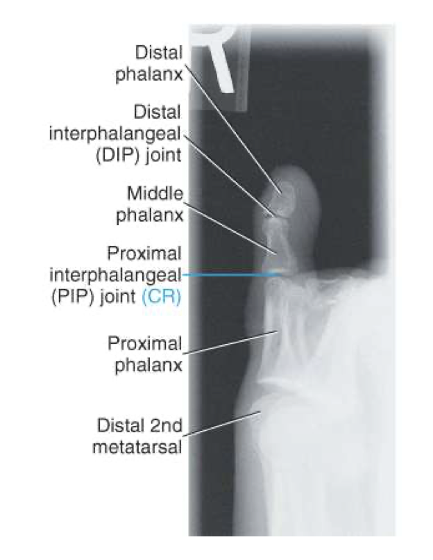 <p><span style="line-height: normal;"><span> </span></span>Digits presented in true lateral position</p><p class="p1"><span style="line-height: normal;"><span> </span></span>Anterior surface is concave</p><p class="p1"><span style="line-height: normal;"><span> </span></span>IP and MTP joints appear open</p><p class="p1"><span style="line-height: normal;"><span> </span></span>Digit free of superimposition</p><p class="p1"><span style="line-height: normal;"><span> </span></span>Optimal exposure factors</p>