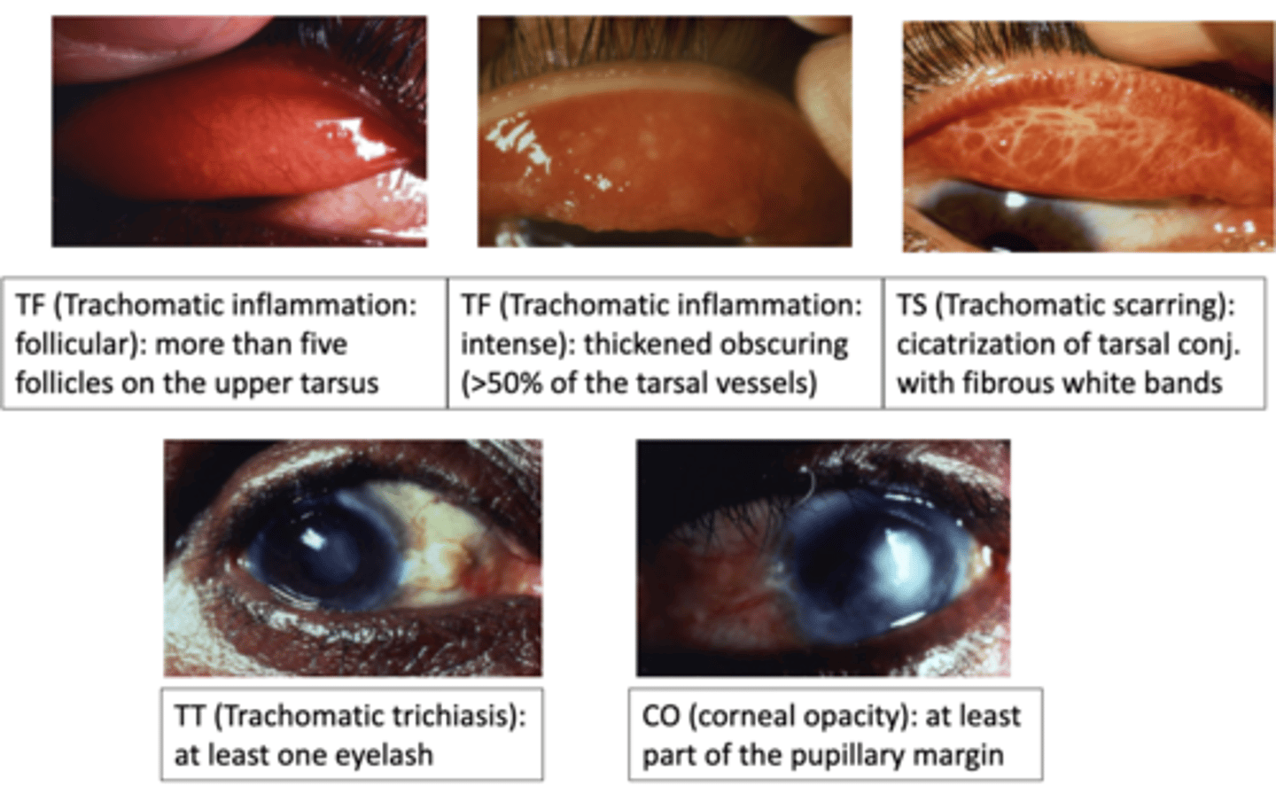 <p>What are the stages of trachoma?</p>