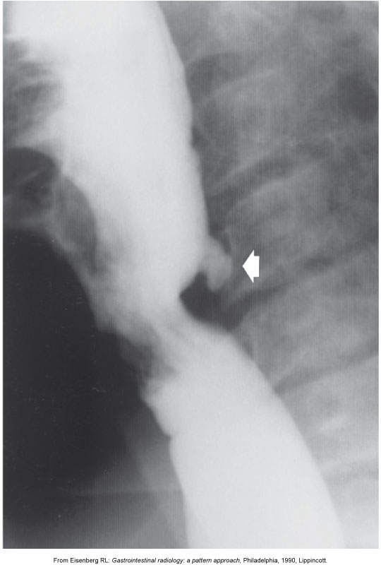 <p>What is the typical radiographic appearance of Zenker’s diverticulum?</p>