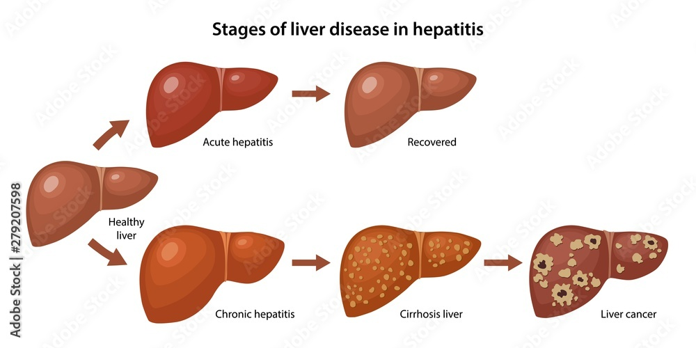 <ul><li><p>hepatitis C</p><ul><li><p>perinatale transmissie wisselend → afhankelijk van virale load moeder (4-14%)</p></li></ul></li><li><p>klachten = <span style="color: red">spider naevi, erythema palmare</span></p></li><li><p>kan leiden tot <span style="color: green">hepatocellulair carcinoom</span></p></li><li><p>diagnostiek</p><ul><li><p><span style="color: blue">lager Hb</span></p></li><li><p><span style="color: blue">hoog ASAT/ALAT/gamma-GT</span></p></li><li><p>(acute hepatitis → ook ontstekingswaardes + koorts)</p></li></ul></li></ul><p></p>