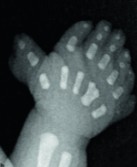 <ol><li><p>What is abnormal about this image?</p></li><li><p>This finding can be associated with what pathology?</p></li></ol><p></p>