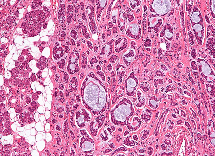 <p>Patient de 60 ans avec masse parotide douloureuse </p><p>1) diagnostic </p><p>2) Clinique (localisation, métastases)</p><p>3) Histologie </p><p>4) IHC</p><p>5) Moléculaire</p>