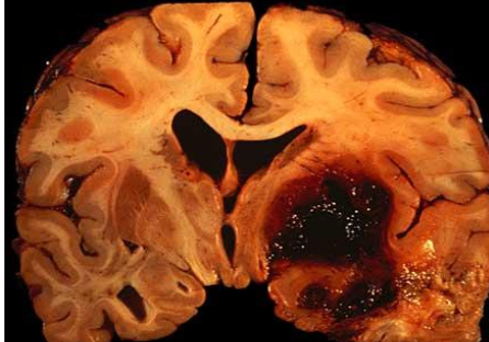 <p>Intracerebral Hemorrhage</p>