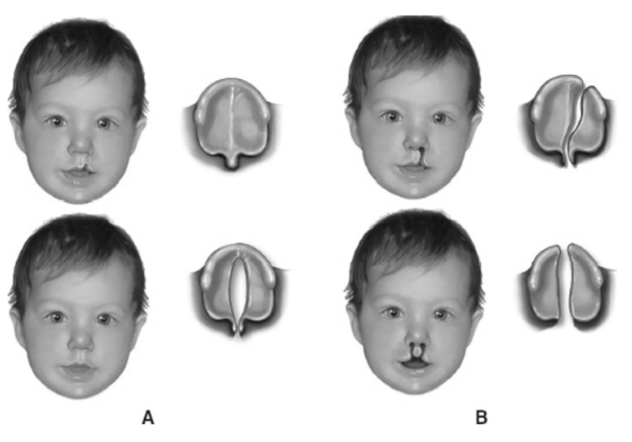 <p>Cleft Lip and Palate</p>