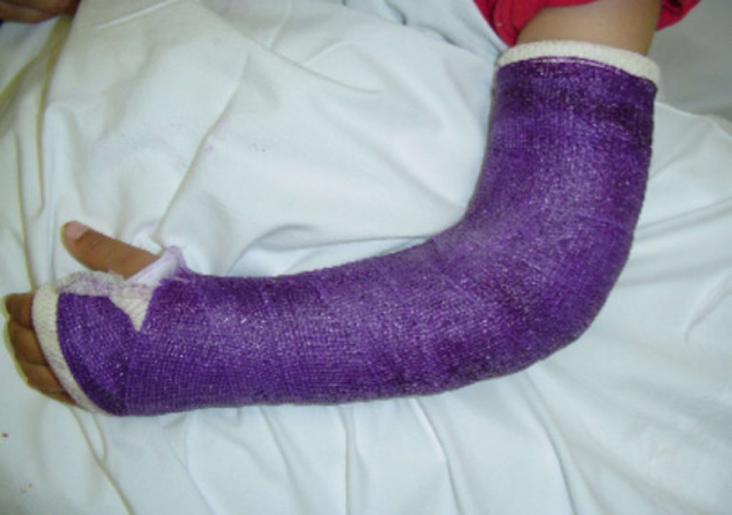 <p>- post injury</p><p>- common with immobilization devices (d/t swelling after insertion of an eg. cast)</p><p>- may take hours to days onset</p>