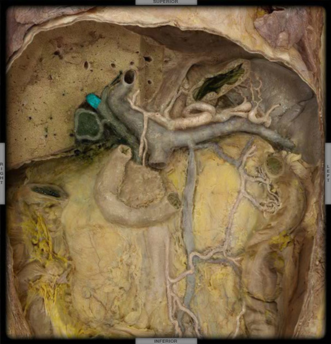<p>The duct that leads from the liver to the common bile duct; transports bile.</p>