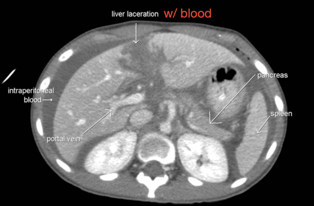 <p><em>CTA Abdomen/Pelvis IV contrast</em></p>