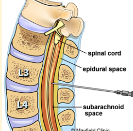 <p>Site for lumbar puncture </p>