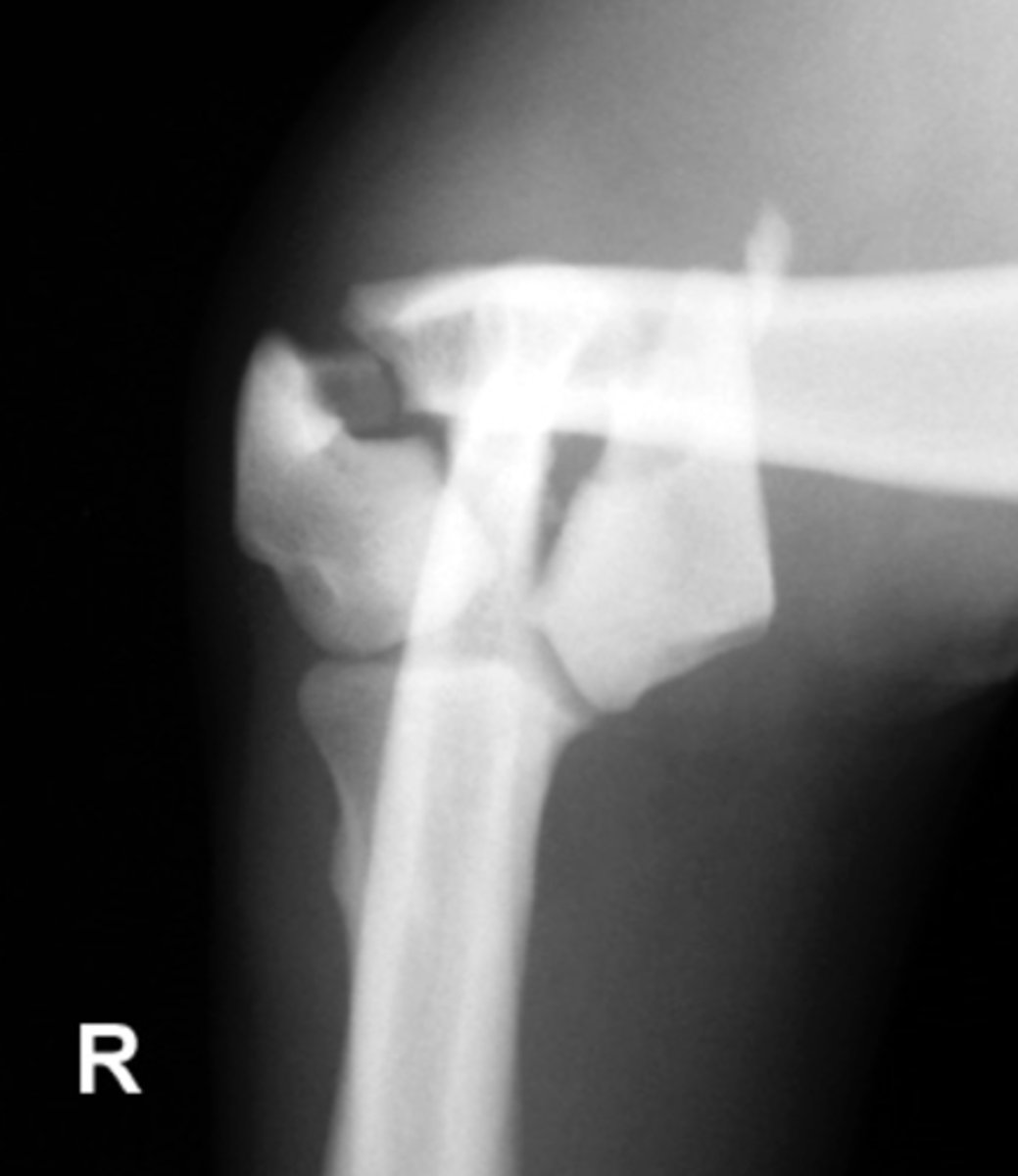 <p>A 5 year old chihuahua comes in what kind of Salter-Harris fracture are we seeing?</p>