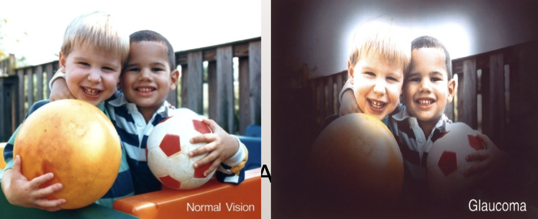 <p>diseases affecting the optic nerve caused by increased pressure in eye - can cause blindness</p><p>slow loss of peripheral vision, decreased ability to see in dim light, blurred vision, tunnel vision</p>