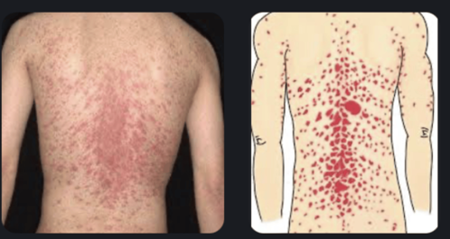 <p>- A self-limiting rash that resolves after 10 weeks</p><p>- Characterised by a herald (coin-shaped) patch and subsequent fir-tree (Christmas tree) pattern eruption</p><p>- common in individuals aged 10-35</p><p>- often have a preceding viral illness</p>