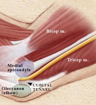 <p>Cubital Tunnel Ulnar Nerve Entrapment causes include prolonged flexion of elbow, trauma to medial elbow, repeated trauma as in leaning on elbow, Inflammation of nerve; as well as a</p>