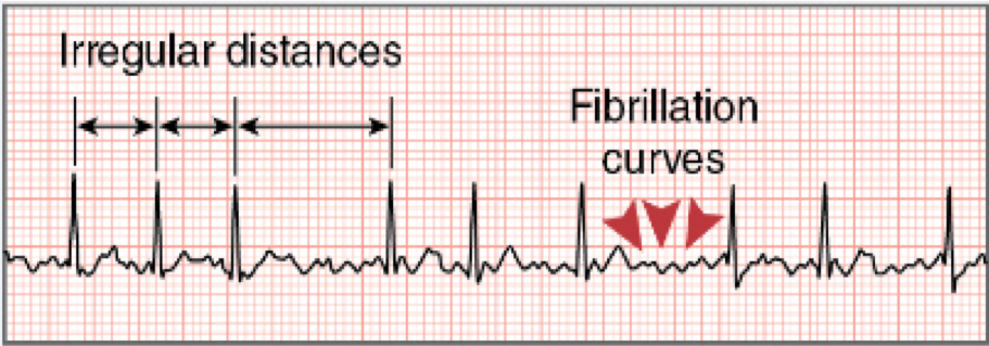 * caused by many ectopic atrial foci firing at rapid rates
* no distinguishable P waves because the atria are sending impulses erratically
* irregular QRS response/distances