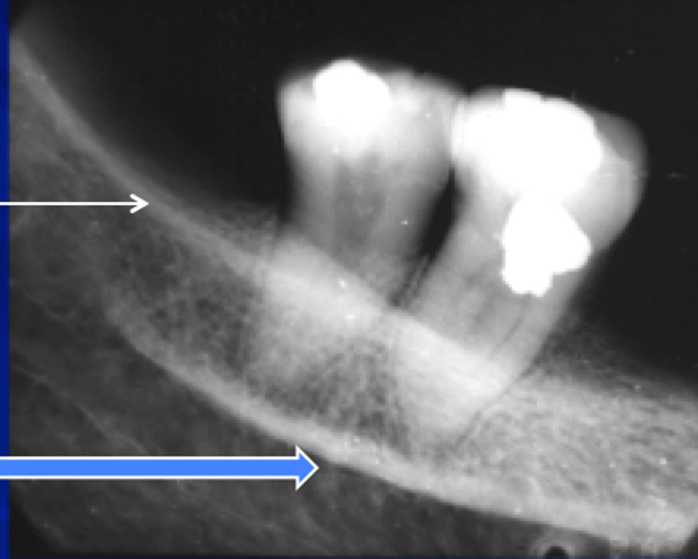 <p>dense white line distal to the last molar and moving across root of molars</p>