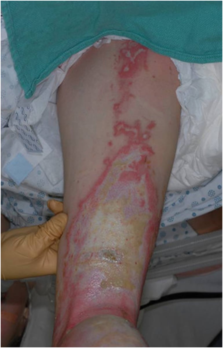 <p>1. areas destroyed = epidermis + full dermis</p><p>2. appearance = creamy, white, moist, may have pseudo-membrane and oedema</p><p>3. sensation = intact but may have decreased light-touch (some nerve endings damaged)</p><p>4. blanching/capillary return = delayed but present</p><p>5. wound closure = >14 days, may need graft</p>