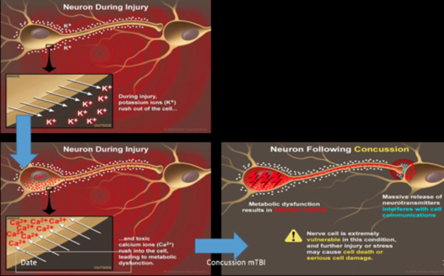 <p>nerve cells under stress:</p><p>- increase glutamate release</p><p>- ion imbalance (influx of Ca+, efflux of K+)</p><p>- increase in energy demand (up-regulation of ATP pumps)</p><p>- decrease blood flow</p><p>= ENERGY CRISIS</p>