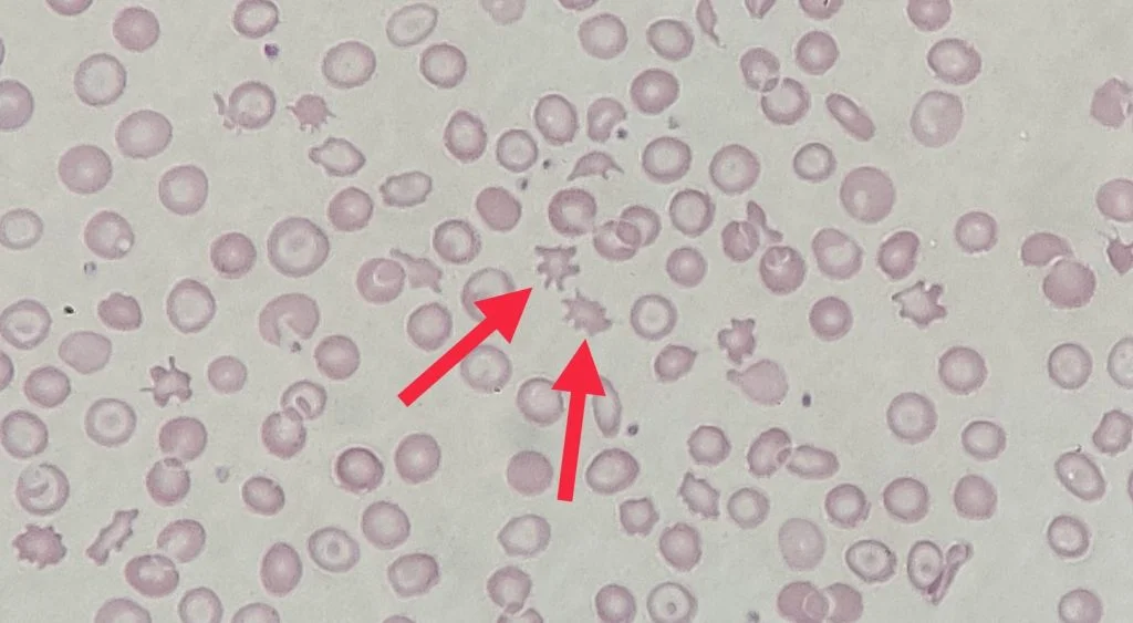 <p>Identify this type of red cell</p>
