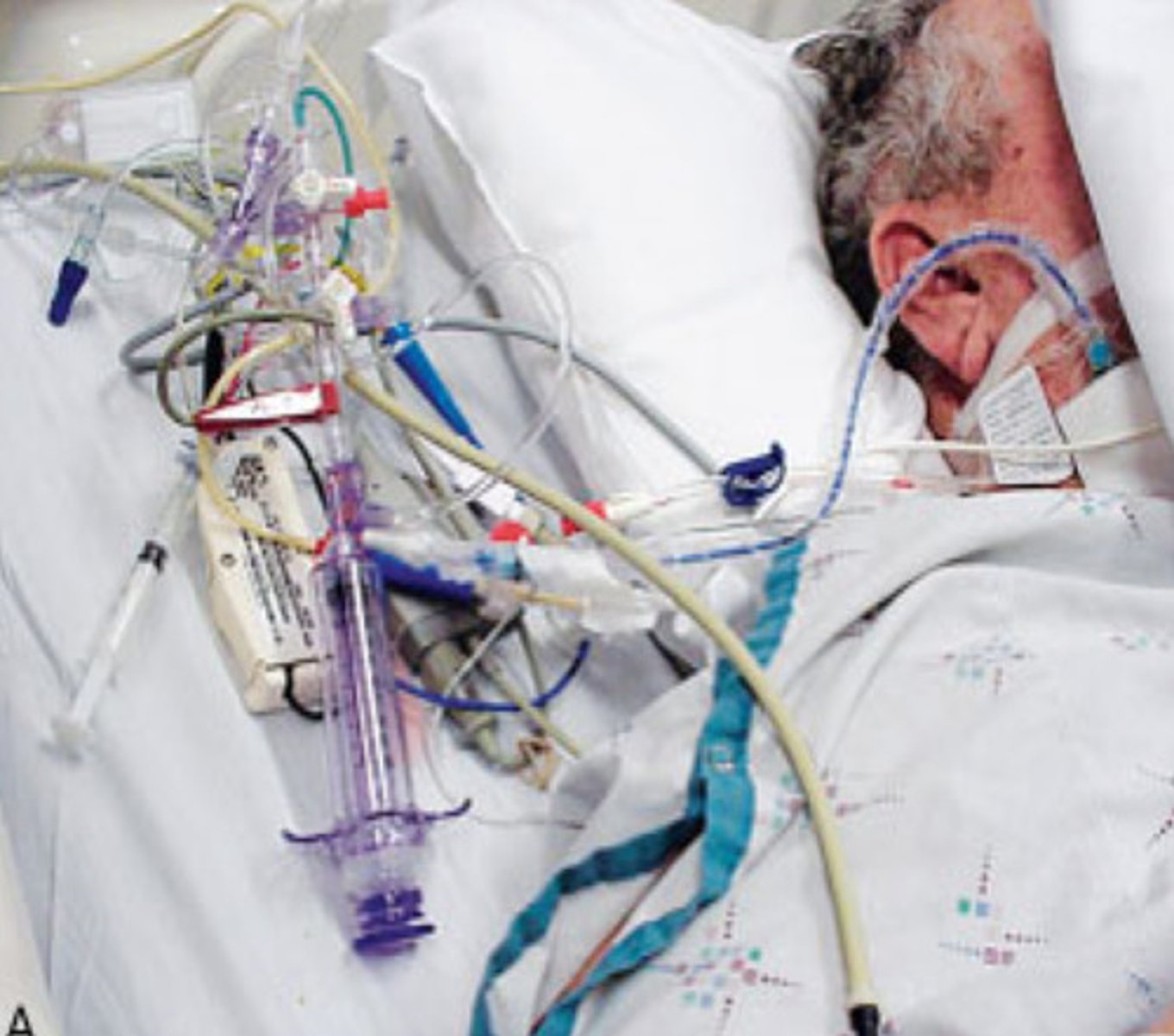 <p>-placed in central vein and is most invasive to measure: CVP, right atrial pressure, pulmonary artery pressure, pulmonary wedge pressure, cardiac output and cardiac index, calculation of systemic and pulmonary vascular resistance, temporary pacing</p><p>-advanced to superior vena cava -> R atrium -> R ventricle -> pulmonary artery</p>