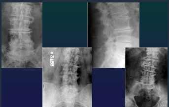 <ul><li><p>Osteophytosis</p><ul><li><p>any segment, at 1st horizontal, then vertical</p></li><li><p>McNab Osteophyte</p></li></ul></li><li><p>Discarthosis </p><ul><li><p>narrowing, bulging, vacuum phenomen</p></li><li><p>OS</p></li><li><p>Intraspongious hernias (schoolroom nodules)</p></li><li><p>Disk calcification</p></li></ul></li></ul><p></p>