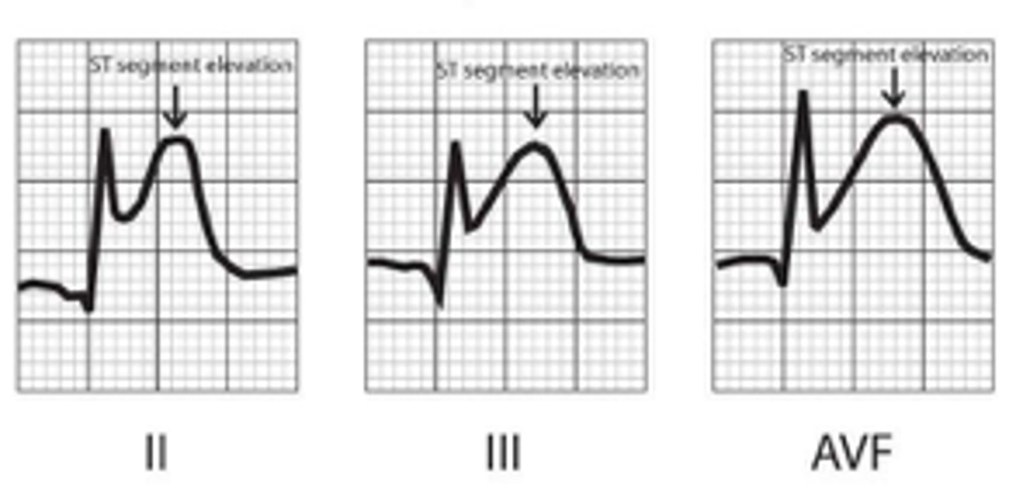 <p>Signs of acute myocardial injury</p>
